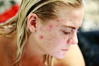 tetralysal tegen acne review