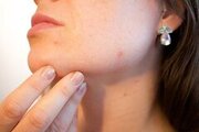 oorzaak van acne achterhalen met de locatie