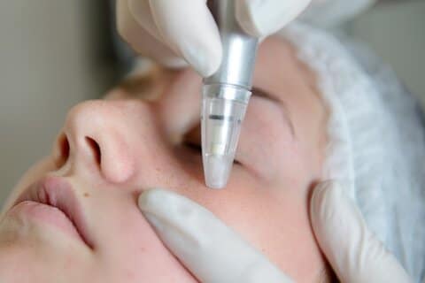 gezichtsbehandeling tegen acne met microdermabrasie