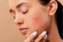 collageen voor acne