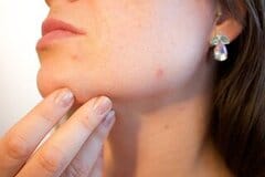 Erytromycine acne ervaringen